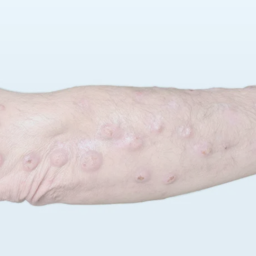 CTI Prurigo Nodularis
