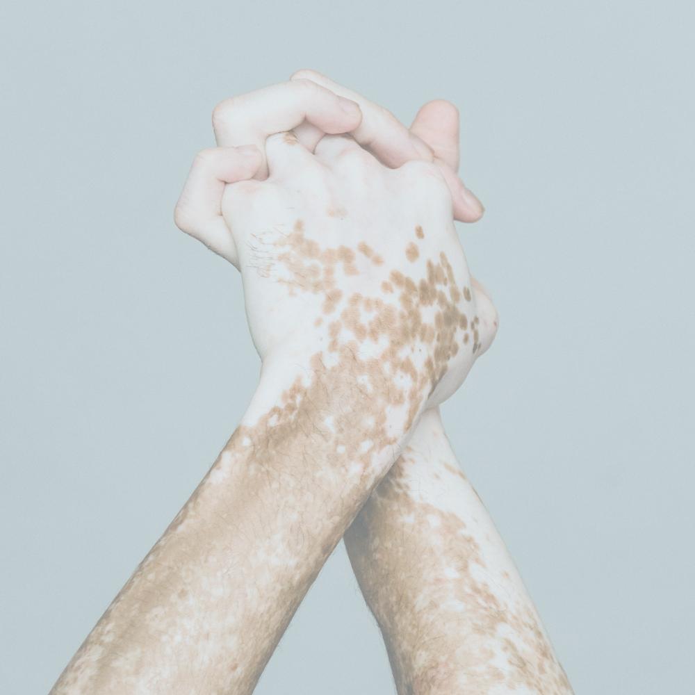 CTI Vitiligo