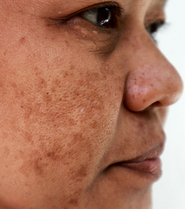 Melasma