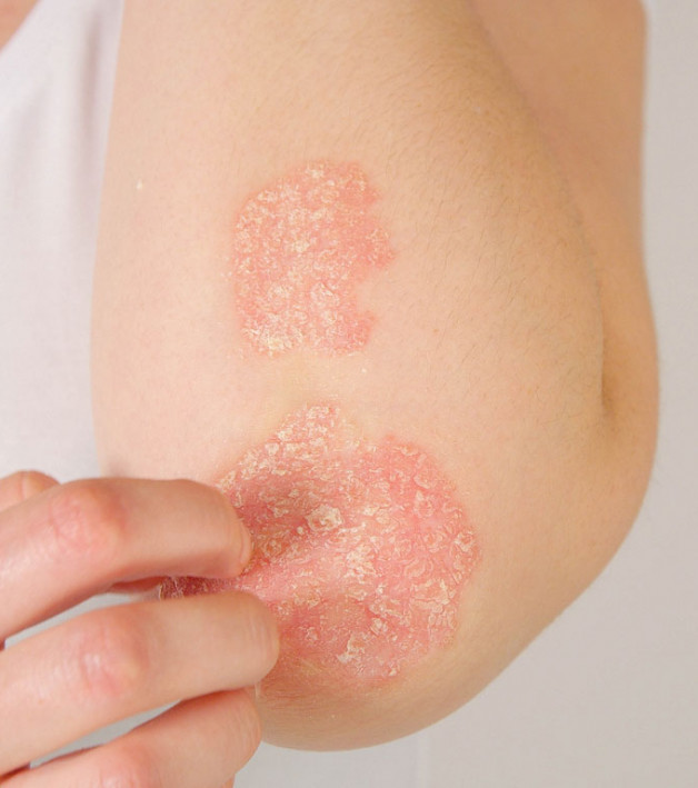 Psoriasis