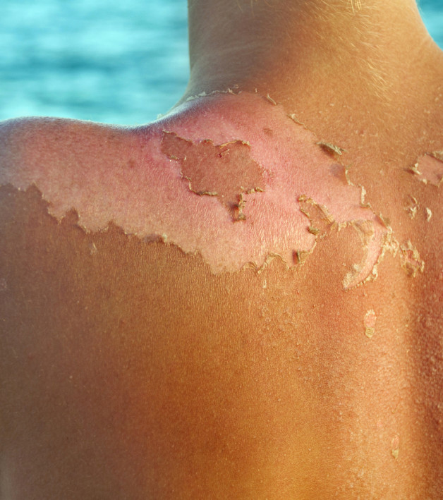 Sun Damage