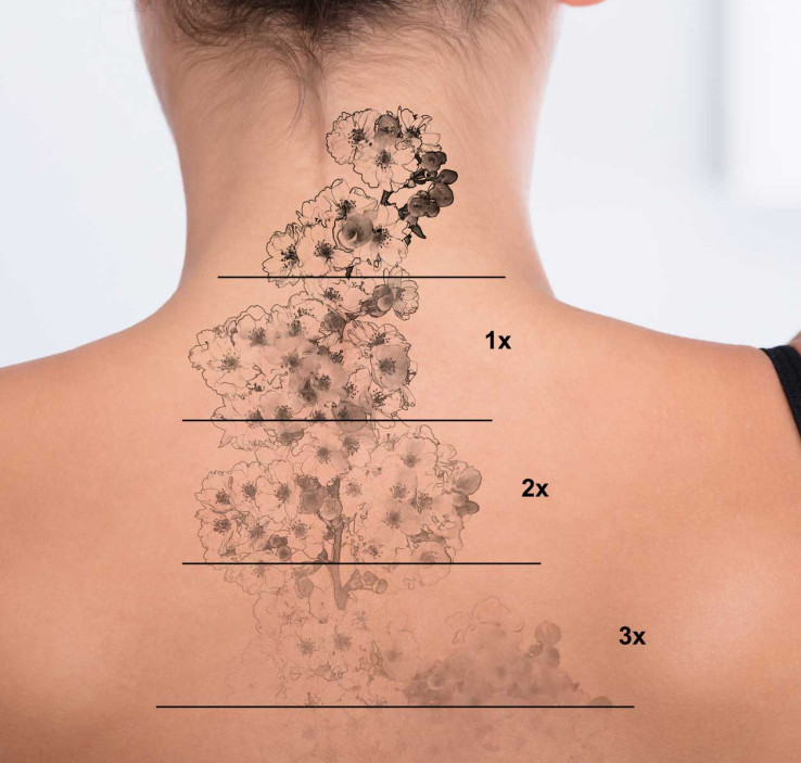 Laser Tattoo Removal