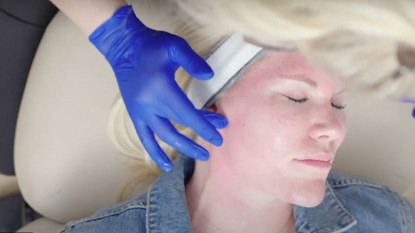 Advanced Microneedling