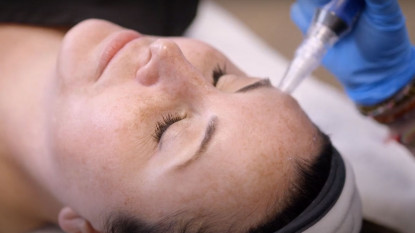 Microneedling