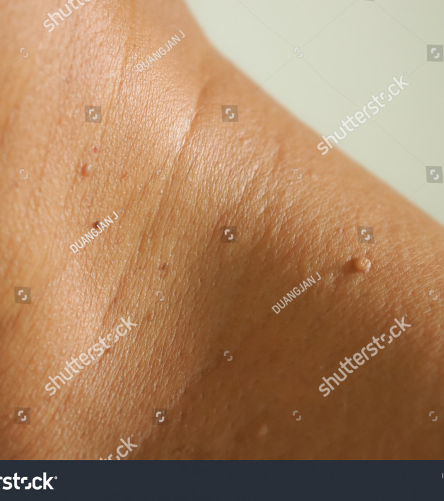 Skin Tags