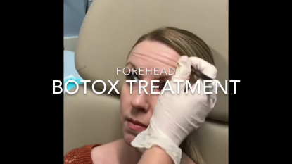 Botox to Forehead