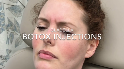 Botox to Glabella