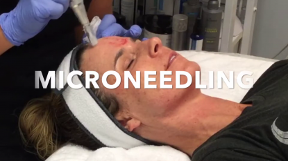 Microneedling