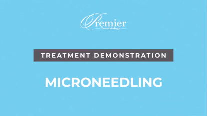 Microneedling