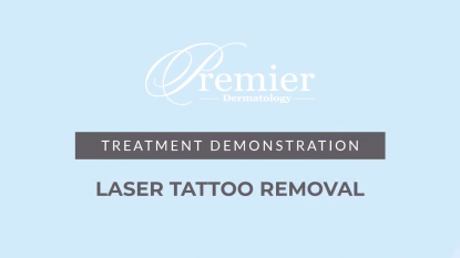 Laser Tattoo Removal